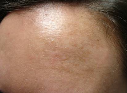 Kanakaris, Heather melasma pock scar pre 004cropped