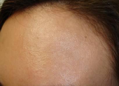 Kanakaris, Heather post IPL fractional pre inj 003cropped2