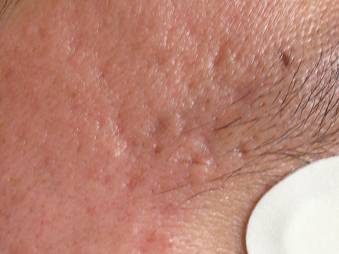 acne pock scars-r temple